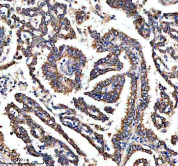 Immunohistochemical staining of RASAL3 using anti-RASAL3 antibody. RASAL3 was detected in a paraffin-embedded section of human lung cancer tissue. Heat mediated antigen retrieval was performed in EDTA buffer (pH 8.0, epitope retrieval solution). The tissue section was blocked with 10% goat serum. The tissue section was then incubated with 2 ug/ml rabbit anti-RASAL3 antibody overnight at 4oC. Peroxidase Conjugated Goat Anti-rabbit IgG was used as secondary antibody and incubated for 30 min at 37oC.