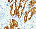 IHC testing of human prostate carcinoma with PSAP antibody (clone PSPN1-1). FFPE testing requires sections to be boiled in pH 9 10mM Tris with 1mM EDTA for 10-20 minutes, followed by cooling at RT for 20 minutes, prior to staining.