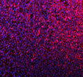 Immunofluorescent staining of SILV/PMEL using anti-PMEL antibody (red). SILV/PMEL was detected in a paraffin-embedded section of human melanoma tissue. Heat mediated antigen retrieval was performed in EDTA buffer (pH 8.0, epitope retrieval solution). The tissue section was blocked with 10% goat serum. The tissue section was then incubated with 5 ug/ml rabbit anti-PMEL antibody overnight at 4oC. DyLight 594 Conjugated Goat Anti-Rabbit IgG was used as secondary antibody at 1:500 dilution and incubated for 30