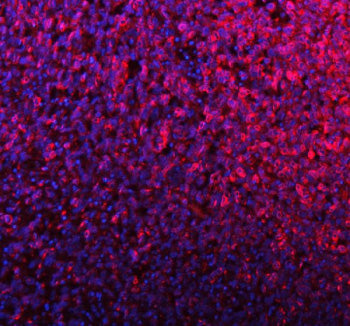Immunofluorescent staining of SILV/PMEL using anti-PMEL antibody (red). SILV/PMEL was detected in a paraffin-embedded section of human melanoma tissue. Heat mediated antigen retrieval was performed in EDTA buffer (pH 8.0, epitope retrieval solution). The tissue section was blocked with 10% goat serum. The tissue section was then incubated with 5 ug/ml rabbit anti-PMEL antibody overnight at 4oC. DyLight 594 Conjugated Goat Anti-Rabbit IgG was used as secondary antibody at 1:500 dilution and incubated for 30