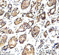 Immunohistochemical staining of OARD1 using anti-OARD1 antibody. OARD1 was detected in a paraffin-embedded section of human breast cancer tissue. Heat mediated antigen retrieval was performed in EDTA buffer (pH 8.0, epitope retrieval solution). The tissue section was blocked with 10% goat serum. The tissue section was then incubated with 2 ug/ml rabbit anti-OARD1 antibody overnight at 4oC. Peroxidase Conjugated Goat Anti-rabbit IgG was used as secondary antibody and incubated for 30 min at 37oC.