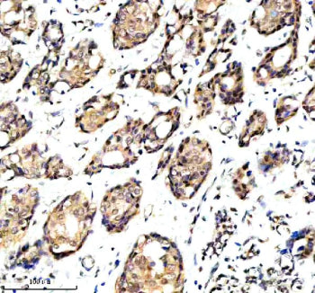 Immunohistochemical staining of OARD1 using anti-OARD1 antibody. OARD1 was detected in a paraffin-embedded section of human breast cancer tissue. Heat mediated antigen retrieval was performed in EDTA buffer (pH 8.0, epitope retrieval solution). The tissue section was blocked with 10% goat serum. The tissue section was then incubated with 2 ug/ml rabbit anti-OARD1 antibody overnight at 4oC. Peroxidase Conjugated Goat Anti-rabbit IgG was used as secondary antibody and incubated for 30 min at 37oC.