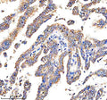Immunohistochemical staining of DEPDC6/DEPTOR using anti-DEPTOR antibody. DEPDC6/DEPTOR was detected in a paraffin-embedded section of human stomach cancer tissue. Heat mediated antigen retrieval was performed in EDTA buffer (pH 8.0, epitope retrieval solution). The tissue section was blocked with 10% goat serum. The tissue section was then incubated with 2 ug/ml rabbit anti-DEPTOR antibody overnight at 4oC.
