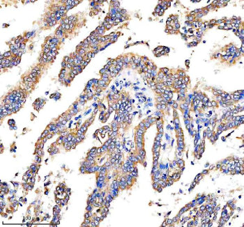 Immunohistochemical staining of DEPDC6/DEPTOR using anti-DEPTOR antibody. DEPDC6/DEPTOR was detected in a paraffin-embedded section of human stomach cancer tissue. Heat mediated antigen retrieval was performed in EDTA buffer (pH 8.0, epitope retrieval solution). The tissue section was blocked with 10% goat serum. The tissue section was then incubated with 2 ug/ml rabbit anti-DEPTOR antibody overnight at 4oC.