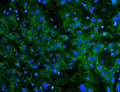 Immunofluorescent staining of FFPE human liver cancer with Cadherin 2 antibody. HIER: boil tissue sections in pH8 EDTA for 20 min and allow to cool before testing.