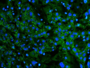 Immunofluorescent staining of FFPE human liver cancer with Cadherin 2 antibody. HIER: boil tissue sections in pH8 EDTA for 20 min and allow to cool before testing.