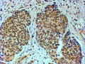 IHC testing of FFPE human breast cancer with TIF1A antibody at 4ug/ml. HIER: steamed with pH6 citrate buffer, HRP-staining.