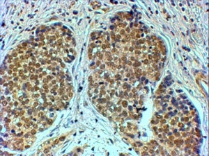 IHC testing of FFPE human breast cancer with TIF1A antibody at 4ug/ml. HIER: steamed with pH6 citrate buffer, HRP-staining.