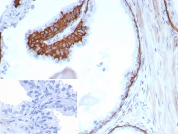 IHC staining of FFPE human prostate tissue with CK13 antibody (clone KRT13/8577R). Inset: PBS used in place of primary Ab (secondary Ab negative control). HIER: boil tissue sections in pH 9 10mM Tris with 1mM EDTA for 20 min and allow to cool before testing.
