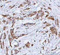 IHC analysis of PHGDH using anti-PHGDH antibody. PHGDH was detected in a paraffin-embedded section of human breast cancer tissue. Heat mediated antigen retrieval was performed in EDTA buffer (pH 8.0, epitope retrieval solution). The tissue section was blocked with 10% goat serum. The tissue section was then incubated with 2 ug/ml rabbit anti-PHGDH antibody overnight at 4oC. Peroxidase Conjugated Goat Anti-rabbit IgG was used as secondary antibody and incubated for 30 min at 37oC.