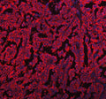 Immunofluorescent staining of FFPE human ovarian cancer tissue with EML4 antibody (red) and DAPI nuclear stain (blue). HIER: steam section in pH8 EDTA buffer for 20 min.
