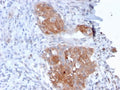 IHC testing of FFPE human bladder carcinoma with Desmoglein 1 antibody (clone 32-2B). HIER: boil tissue sections in pH 9 10mM Tris with 1mM EDTA for 10-20 min.