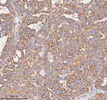 Immunohistochemical staining of SLC7A7 using anti-SLC7A7 antibody. SLC7A7 was detected in a paraffin-embedded section of human ovarian cancer tissue. Heat mediated antigen retrieval was performed in EDTA buffer (pH 8.0, epitope retrieval solution). The tissue section was blocked with 10% goat serum. The tissue section was then incubated with 2 ug/ml rabbit anti-SLC7A7 antibody overnight at 4oC. Peroxidase Conjugated Goat Anti-rabbit IgG was used as secondary antibody and incubated for 30 min at 37oC.