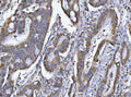 IHC staining of FFPE human colon adenocarcinoma tissue with PCCB antibody. HIER: boil tissue sections in pH8 EDTA for 20 min and allow to cool before testing.