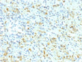 IHC staining of FFPE human Ewing Sarcoma tissue with recombinant Anaplastic Lymphoma Kinase antibody (clone ALK1/9660R). HIER: boil tissue sections in pH 9 10mM Tris with 1mM EDTA for 20 min and allow to cool before testing.