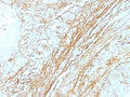 IHC: Formalin-fixed, paraffin-embedded human lung carcinoma stained with Tenascin C antibody (T2H5) at 4ug/ml. Antigen retrieval in 10mM Tris with 1mM EDTA, pH 9.0; ABC detection system with DAB Chromogen. Note staining of connective tissue.