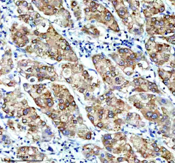 Immunohistochemical staining of CBR1 using anti-CBR1 antibody. CBR1 was detected in a paraffin-embedded section of human liver cancer tissue. Heat mediated antigen retrieval was performed in EDTA buffer (pH 8.0, epitope retrieval solution). The tissue section was blocked with 10% goat serum. The tissue section was then incubated with 1:50 rabbit anti-CBR1 antibody overnight at 4oC. Peroxidase Conjugated Goat Anti-rabbit IgG was used as secondary antibody and incubated for 30 min at 37oC.