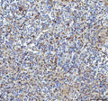 IHC staining of FFPE human glioma tissue with Pleiotrophin antibody, HRP-labeled secondary and DAB substrate. HIER: boil tissue sections in pH8 EDTA for 20 min and allow to cool before testing.