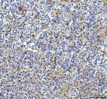 IHC staining of FFPE human glioma tissue with Pleiotrophin antibody, HRP-labeled secondary and DAB substrate. HIER: boil tissue sections in pH8 EDTA for 20 min and allow to cool before testing.
