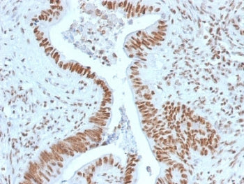 IHC staining of FFPE human colon carcinoma with Nucleophosmin antibody. HIER: boil tissue sections in pH6, 10mM citrate buffer, for 10-20 min and allow to cool before testing.