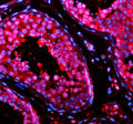 Immunofluorescent staining of TSN using anti-Translin antibody (red). TSN was detected in a paraffin-embedded section of human testis tissue. Heat mediated antigen retrieval was performed in EDTA buffer (pH 8.0, epitope retrieval solution). The tissue section was blocked with 10% goat serum. The tissue section was then incubated with 5 ug/ml rabbit anti-Translin antibody overnight at 4oC. Cy3 Conjugated Goat Anti-Rabbit IgG was used as secondary antibody at 1:500 dilution and incubated for 30 min at 37oC.