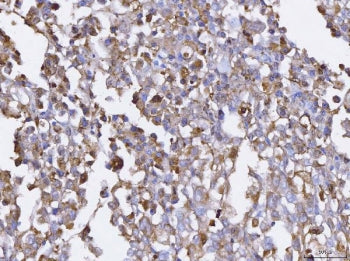 IHC staining of FFPE human pancreatic cancer tissue with BCAT1 antibody. HIER: boil tissue sections in pH8 EDTA for 20 min and allow to cool before testing.