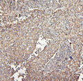 IHC staining of FFPE human lung cancer with MVP antibody. HIER: boil tissue sections in pH6, 10mM citrate buffer, for 20 min and allow to cool before testing.