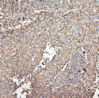IHC staining of FFPE human lung cancer with MVP antibody. HIER: boil tissue sections in pH6, 10mM citrate buffer, for 20 min and allow to cool before testing.