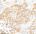Immunohistochemical staining of RAB27B using anti-RAB27B antibody. RAB27B was detected in a paraffin-embedded section of human bladder cancer tissue. Heat mediated antigen retrieval was performed in EDTA buffer (pH 8.0, epitope retrieval solution). The tissue section was blocked with 10% goat serum. The tissue section was then incubated with 2 ug/ml rabbit anti-RAB27B antibody overnight at 4oC. Peroxidase Conjugated Goat Anti-rabbit IgG was used as secondary antibody and incubated for 30 min at 37oC.