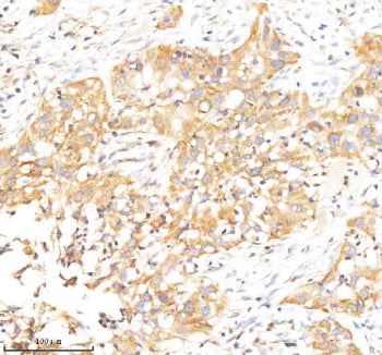 Immunohistochemical staining of RAB27B using anti-RAB27B antibody. RAB27B was detected in a paraffin-embedded section of human bladder cancer tissue. Heat mediated antigen retrieval was performed in EDTA buffer (pH 8.0, epitope retrieval solution). The tissue section was blocked with 10% goat serum. The tissue section was then incubated with 2 ug/ml rabbit anti-RAB27B antibody overnight at 4oC. Peroxidase Conjugated Goat Anti-rabbit IgG was used as secondary antibody and incubated for 30 min at 37oC.