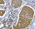 IHC staining of FFPE human breast cancer tissue with Ataxin-2 antibody. HIER: boil tissue sections in pH8 EDTA for 20 min and allow to cool before testing.