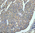 IHC staining of FFPE human cervical cancer tissue with SLC16A1 antibody, HRP-secondary and DAB substrate. HIER: boil tissue sections in pH8 EDTA for 20 min and allow to cool before testing.
