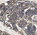 Immunohistochemical staining of PTCD3 using anti-PTCD3 antibody. PTCD3 was detected in a paraffin-embedded section of human colon cancer tissue. Heat mediated antigen retrieval was performed in EDTA buffer (pH 8.0, epitope retrieval solution). The tissue section was blocked with 10% goat serum. The tissue section was then incubated with 2 ug/ml rabbit anti-PTCD3 antibody overnight at 4oC. Peroxidase Conjugated Goat Anti-rabbit IgG was used as secondary antibody and incubated for 30 min at 37oC.