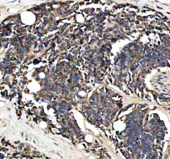 Immunohistochemical staining of PTCD3 using anti-PTCD3 antibody. PTCD3 was detected in a paraffin-embedded section of human colon cancer tissue. Heat mediated antigen retrieval was performed in EDTA buffer (pH 8.0, epitope retrieval solution). The tissue section was blocked with 10% goat serum. The tissue section was then incubated with 2 ug/ml rabbit anti-PTCD3 antibody overnight at 4oC. Peroxidase Conjugated Goat Anti-rabbit IgG was used as secondary antibody and incubated for 30 min at 37oC.