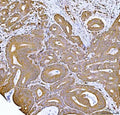 IHC staining of FFPE human rectal cancer tissue with FKBP1A/B antibody. HIER: boil tissue sections in pH8 EDTA for 20 min and allow to cool before testing.