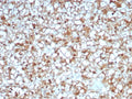 IHC staining of FFPE human renal cell carcinoma tissue with ADH1L1 antibody (clone ALDH1L1/7969). HIER: boil tissue sections in pH 9 10mM Tris with 1mM EDTA for 20 min and allow to cool before testing.