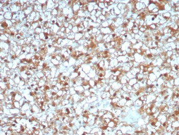 IHC staining of FFPE human renal cell carcinoma tissue with ADH1L1 antibody (clone ALDH1L1/7969). HIER: boil tissue sections in pH 9 10mM Tris with 1mM EDTA for 20 min and allow to cool before testing.