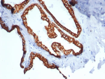 IHC staining of FFPE human prostate carcinoma tissue with recombinant KRT18 antibody (clone rKRT18/7299). HIER: boil tissue sections in pH 9 10mM Tris with 1mM EDTA for 20 min and allow to cool before testing.