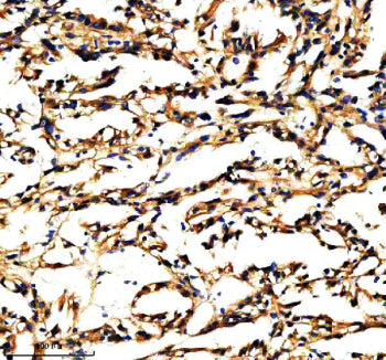 Immunohistochemical staining of PXDN using anti-PXDN antibody. PXDN was detected in a paraffin-embedded section of human renal cancer tissue. Heat mediated antigen retrieval was performed in EDTA buffer (pH 8.0, epitope retrieval solution). The tissue section was blocked with 10% goat serum. The tissue section was then incubated with 2 ug/ml rabbit anti-PXDN antibody overnight at 4oC. Peroxidase Conjugated Goat Anti-rabbit IgG was used as secondary antibody and incubated for 30 min at 37oC.