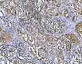 IHC staining of FFPE human lymph node carcinoma tissue with Bcl10 antibody. HIER: boil tissue sections in pH8 EDTA for 20 min and allow to cool before testing.