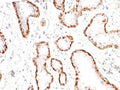 Calponin 1 Antibody Breast Carcinoma IHC. Immunohistochemistry analysis of FFPE human breast carcinoma tissue using Calponin 1 antibody. The mouse monoclonal antibody clone CNN1/832 shows strong HRP-DAB brown cytoplasmic staining in myoepithelial cells surrounding malignant glandular structures, while tumor epithelial cells remain largely negative.