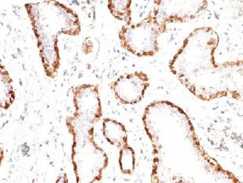 Calponin 1 Antibody Breast Carcinoma IHC. Immunohistochemistry analysis of FFPE human breast carcinoma tissue using Calponin 1 antibody. The mouse monoclonal antibody clone CNN1/832 shows strong HRP-DAB brown cytoplasmic staining in myoepithelial cells surrounding malignant glandular structures, while tumor epithelial cells remain largely negative.