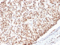 IHC staining of FFPE human breast carcinoma with Estrogen Receptor alpha antibody (clone ESR1/3565). HIER: boil tissue sections in pH 9 10mM Tris with 1mM EDTA for 20 min and allow to cool before testing.