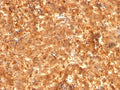 AFP Antibody HepG2 Cell IF. Immunofluorescence analysis of PFA-fixed human HepG2 cells using AFP Antibody (clones C2 + C3 + MBS-12, green) shows cytoplasmic and perinuclear staining consistent with Alpha fetoprotein localization within the secretory pathway of hepatocyte-derived cells. Redot nuclear counterstain (red) provides contrast to cell nuclei. The punctate cytoplasmic distribution supports detection of AFP as a secreted tumor marker protein in liver cancer cell models.