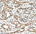Immunohistochemical staining of Histone H3 (acetyl K9) using anti-Histone H3 (acetyl K9) antibody. Histone H3 (acetyl K9) was detected in a paraffin-embedded section of human breast cancer tissue. Heat mediated antigen retrieval was performed in EDTA buffer (pH 8.0, epitope retrieval solution). The tissue section was blocked with 10% goat serum. The tissue section was then incubated with a dilution of 1:50 rabbit anti-Histone H3 (acetyl K9) antibody overnight at 4oC. Peroxidase Conjugated Goat Anti-rabbit I