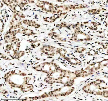 Immunohistochemical staining of Histone H3 (acetyl K9) using anti-Histone H3 (acetyl K9) antibody. Histone H3 (acetyl K9) was detected in a paraffin-embedded section of human breast cancer tissue. Heat mediated antigen retrieval was performed in EDTA buffer (pH 8.0, epitope retrieval solution). The tissue section was blocked with 10% goat serum. The tissue section was then incubated with a dilution of 1:50 rabbit anti-Histone H3 (acetyl K9) antibody overnight at 4oC. Peroxidase Conjugated Goat Anti-rabbit I