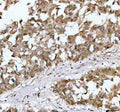 Immunohistochemical staining of NR1D2 using anti-NR1D2 antibody. NR1D2 was detected in a paraffin-embedded section of human liver cancer tissue. Heat mediated antigen retrieval was performed in EDTA buffer (pH 8.0, epitope retrieval solution). The tissue section was blocked with 10% goat serum. The tissue section was then incubated with 2 ug/ml rabbit anti-NR1D2 antibody overnight at 4oC. Peroxidase Conjugated Goat Anti-rabbit IgG was used as secondary antibody and incubated for 30 min at 37oC.