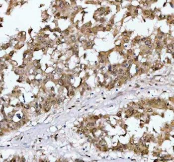 Immunohistochemical staining of NR1D2 using anti-NR1D2 antibody. NR1D2 was detected in a paraffin-embedded section of human liver cancer tissue. Heat mediated antigen retrieval was performed in EDTA buffer (pH 8.0, epitope retrieval solution). The tissue section was blocked with 10% goat serum. The tissue section was then incubated with 2 ug/ml rabbit anti-NR1D2 antibody overnight at 4oC. Peroxidase Conjugated Goat Anti-rabbit IgG was used as secondary antibody and incubated for 30 min at 37oC.