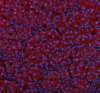 Immunofluorescent staining of MSTO1 using anti-MSTO1 antibody (red). MSTO1 was detected in a paraffin-embedded section of human liver cancer tissue. Heat mediated antigen retrieval was performed in EDTA buffer (pH 8.0, epitope retrieval solution). The tissue section was blocked with 10% goat serum. The tissue section was then incubated with 5 ug/ml rabbit anti-MSTO1 antibody overnight at 4oC.