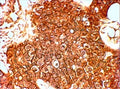 IHC staining of HER+ FFPE human breast cancer with HER2 antibody at 4ug/ml. HIER: Steamed with pH6 citrate buffer, HRP-staining.